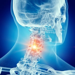 Medical illustration highlighting cervical spine pain and inflammation in the neck, commonly treated with physical therapy.