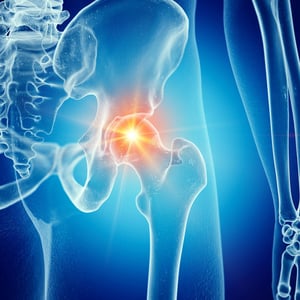 Medical illustration highlighting hip joint pain and inflammation, commonly treated with physical therapy to improve mobility and reduce pain.