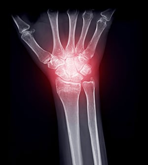 X-ray image of the wrist showing joint inflammation and wrist pain, commonly treated with physical therapy and rehabilitation.