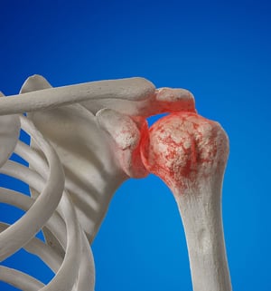 Medical illustration of a shoulder joint showing inflammation and pain.