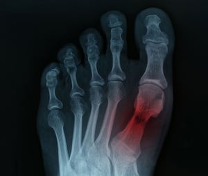 X-ray image of a foot showing pain in the big toe joint.