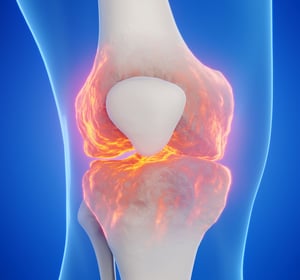 Medical illustration of knee joint inflammation highlighting knee pain and arthritis.